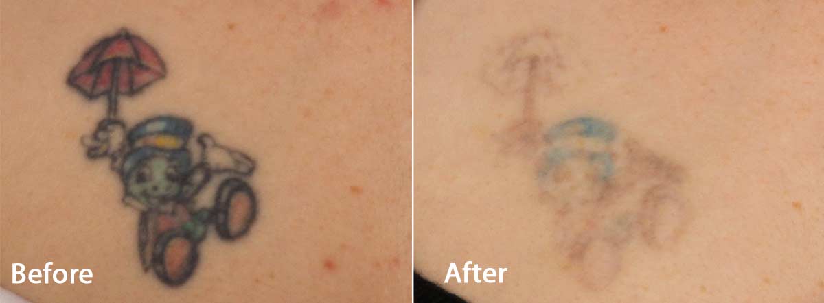 How does laser tattoo removal work  Blue green red and black ink   YouTube