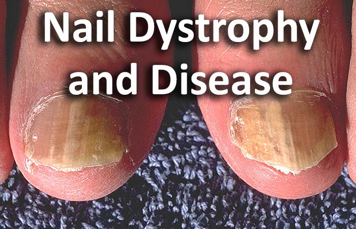 Nail Dystrophy and Disease