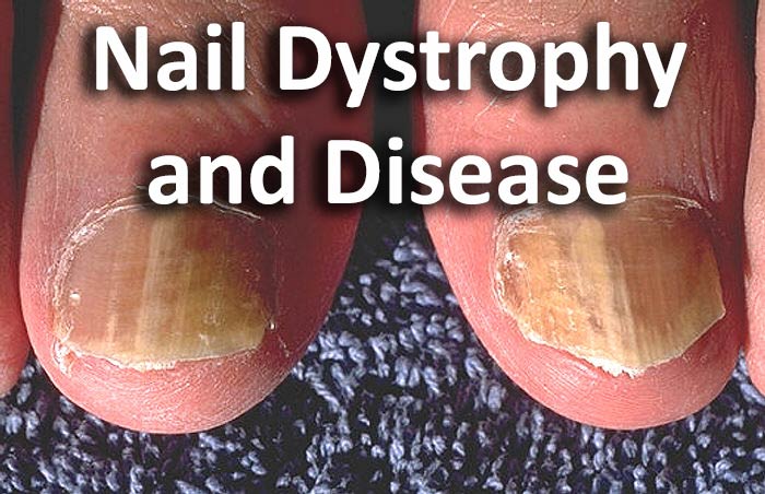 Dystrophic Nails: Symptoms, Causes & Treatment