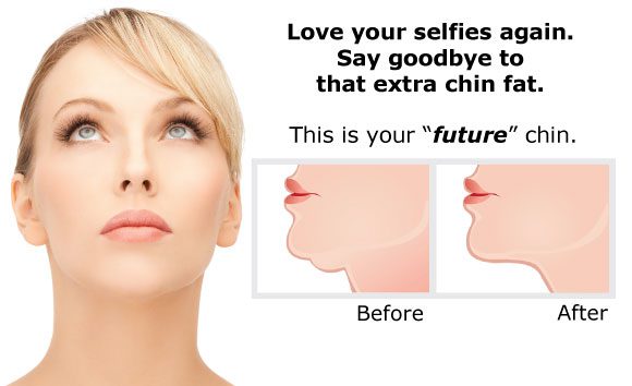 Love your selfies again! Try Kybella!