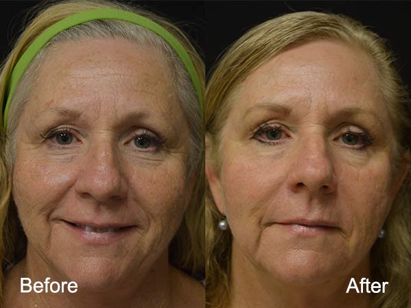 Contour Dermatology – pico-way-resolve-before-after