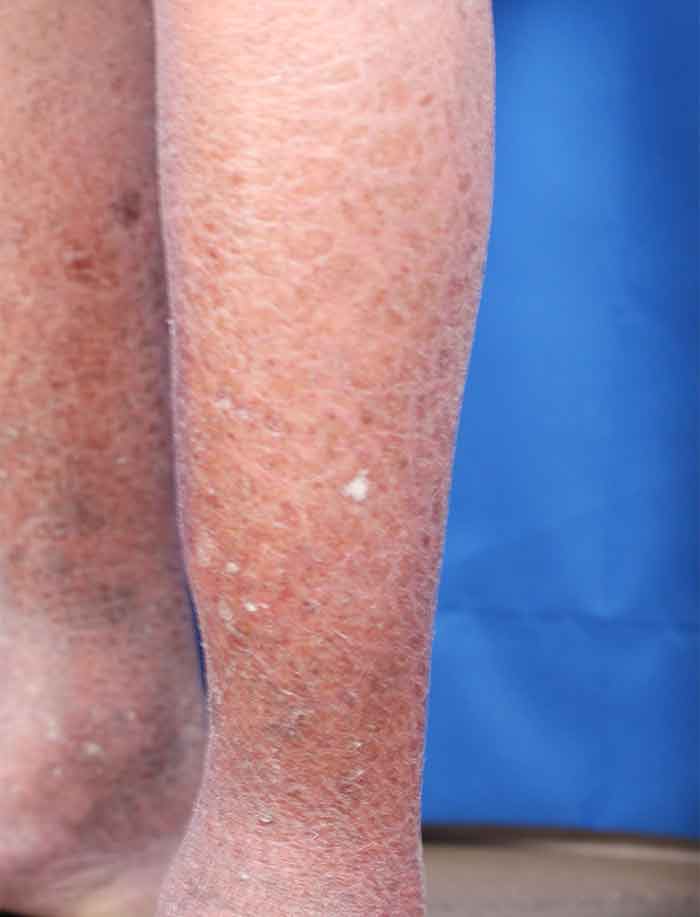 What Causes Dry Scaly Skin On Lower Legs