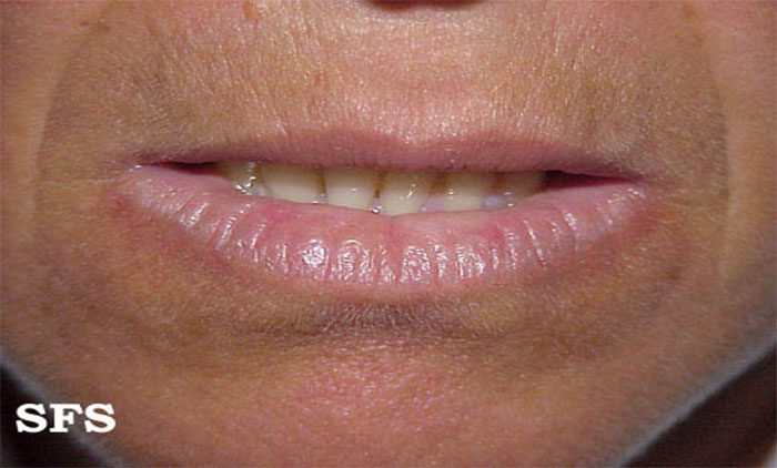 What is Actinic Cheilitis? | Contour Dermatology