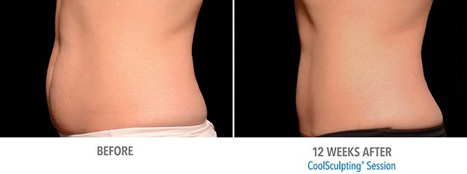 CoolSculpting Stomach