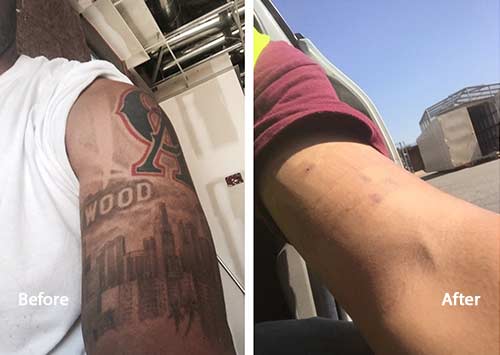 PicoWay Tattoo Removal before and after photo