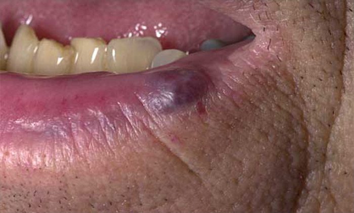 A venous lake is a common vascular deformity that can appear on the vermilion border of the lip, on the ear, or on the face.