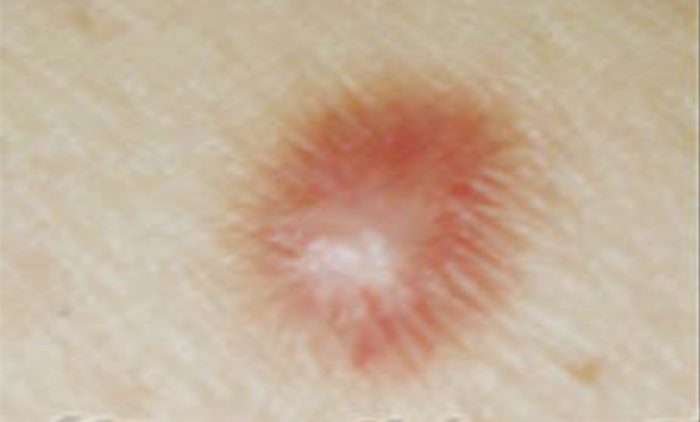 Dermatofibroma Condition, Treatments, and Pictures for ...