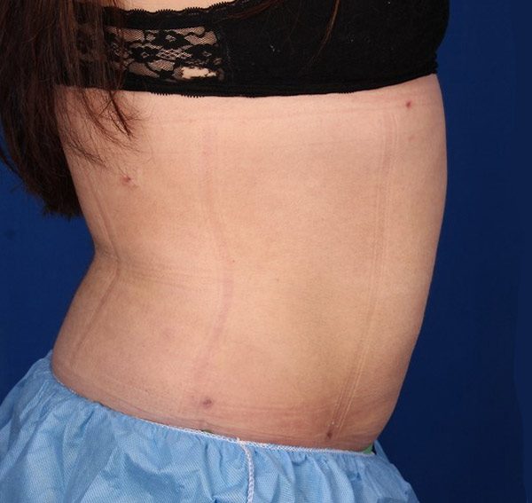 liposuction-right-side-after-080816.jpg