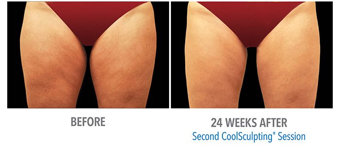 CoolSculpting thighs