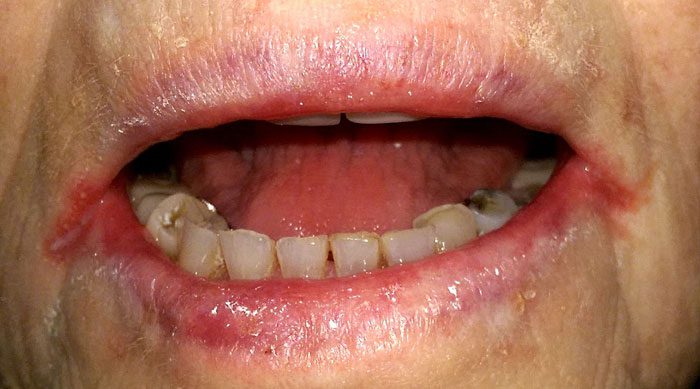 Angular cheilitis example. See corners of mouth.