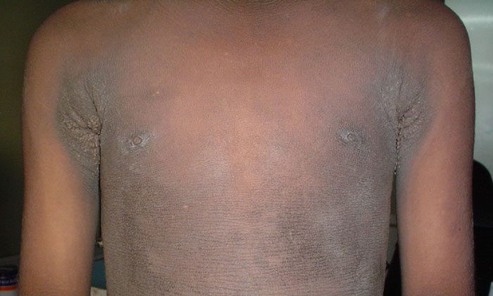 Familial Acanthosis Nigricans