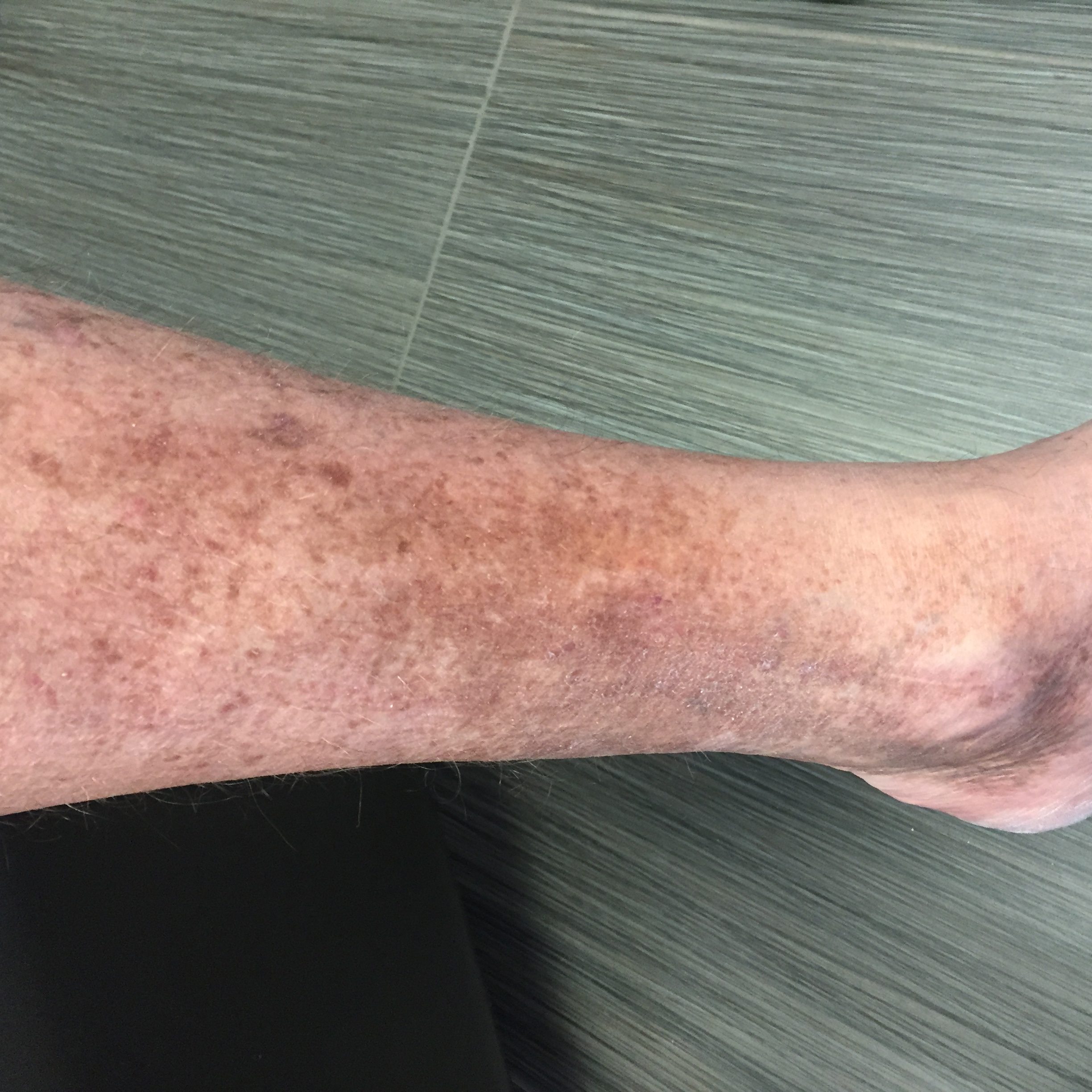 Stasis Dermatitis | Contour Dermatology