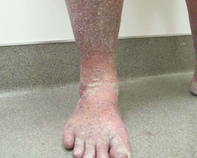 Ichthyosis Vulgaris: The most common type, causing mild to moderate scaling and dryness of the skin.