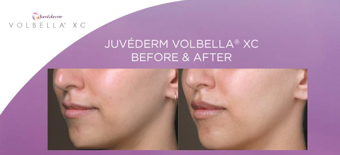 Contour Dermatology Juvederm Volbella Before and After | Contour ...