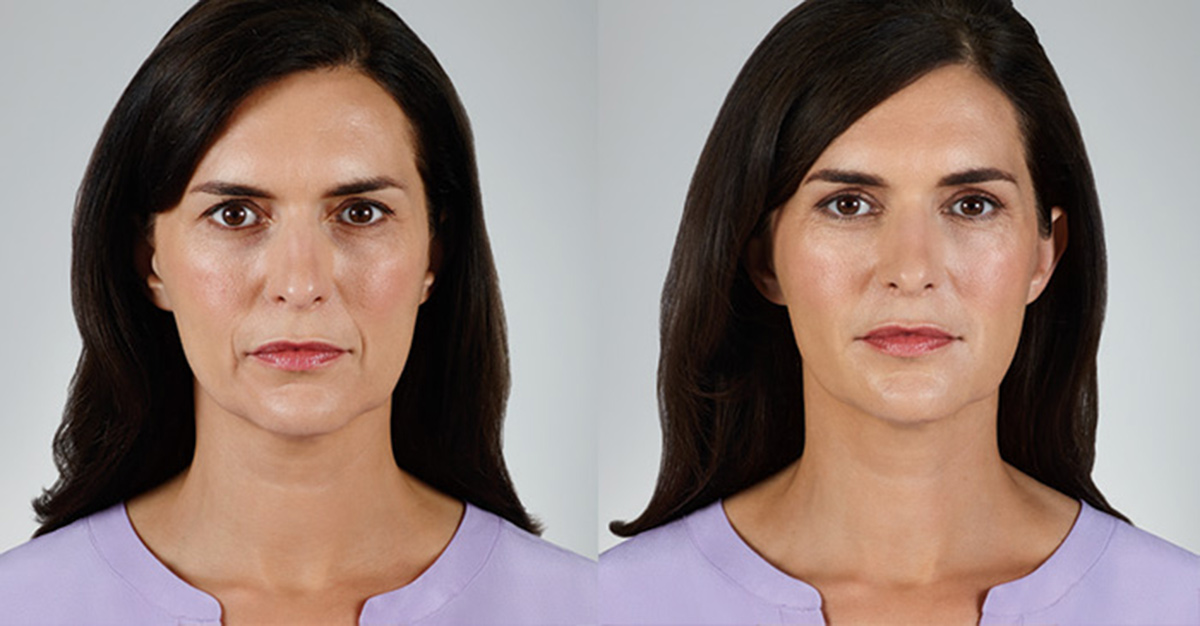 Contour Dermatology Juvederm Facial Filler Contour Dermatology