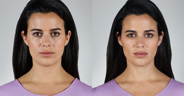 Juvederm Vollure Before and After