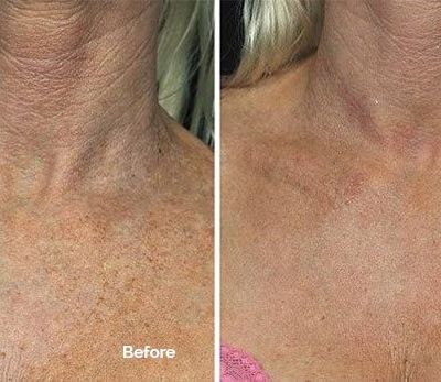 Fraxel for Décolletage before and after photo