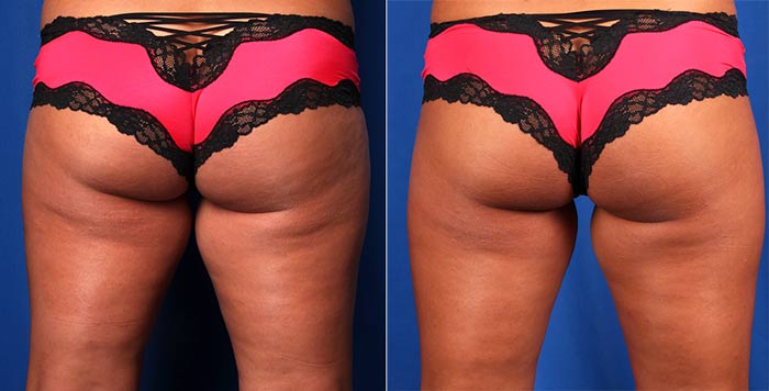 CoolSculpting is available for the thighs.