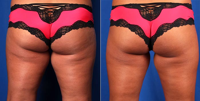 Before and After Inner Thigh Lightning