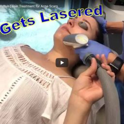 07-4-2017-Jackie Gets Lasered!! | Contour Dermatology