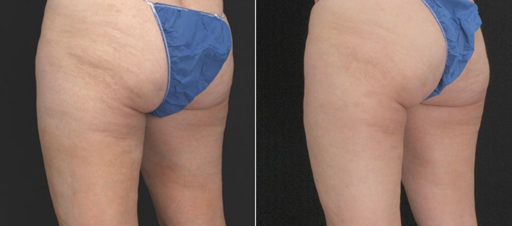 Profound for Cellulite Before and After