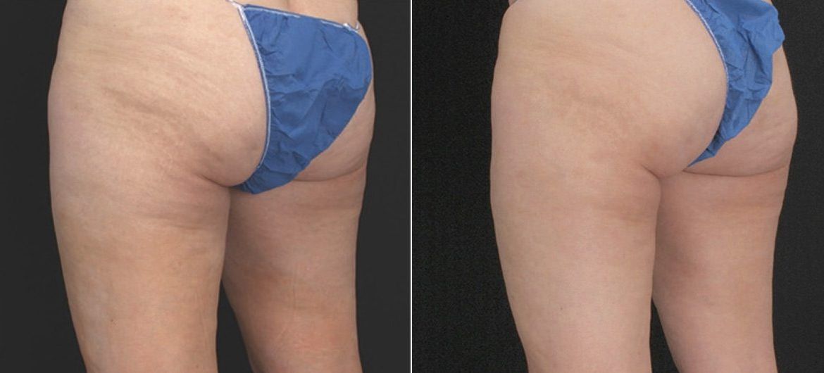 Profound for Cellulite Before and After