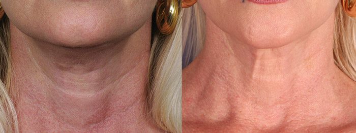 Fillers In Uncommon Places Contour Dermatology 