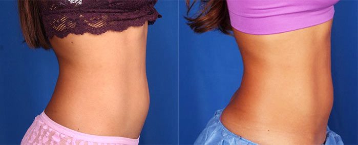 CoolSculpting - Upper & Lower Flanks Before & After Gallery - Case 4437