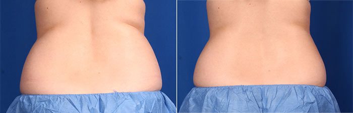 CoolSculpting Flanks before and after