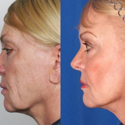 mini-facelift-before-after-1-5-lg