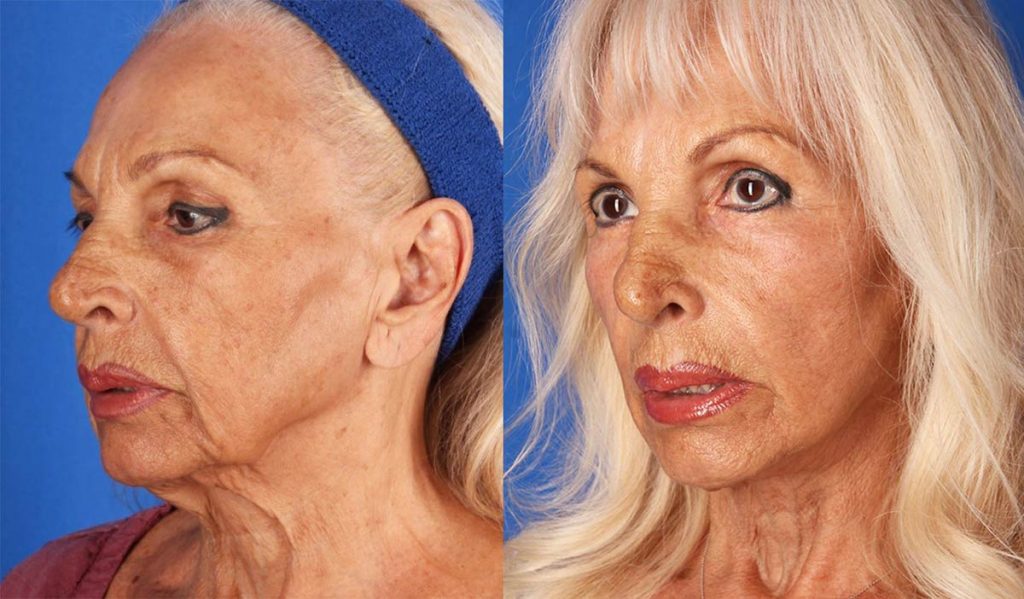 contour-dermatology-mini-facelift-by-dr-timothy-jochen-contour