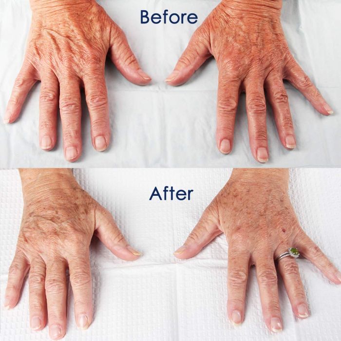 Hand Rejuvenation, Don’t let your hands give away your age!