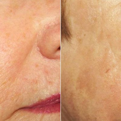 PicoWay Resolve Laser Before and After