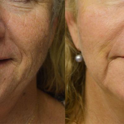 PicoWay Resolve Laser Before and After