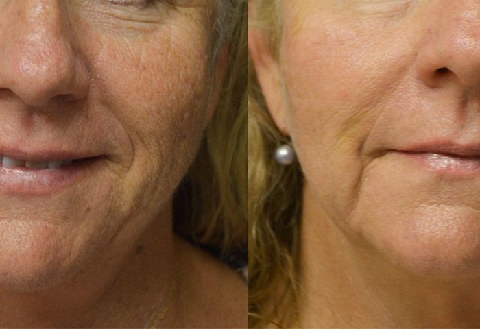 PicoWay Resolve Laser Before and After