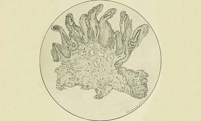 condyloma acuminata genital treatment