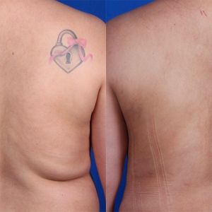 Lipo in the back area before and after