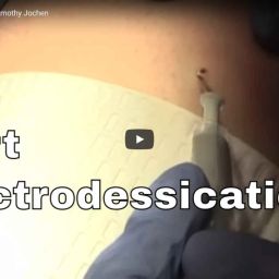 02-05-2018- Common Wart Removal | Contour Dermatology