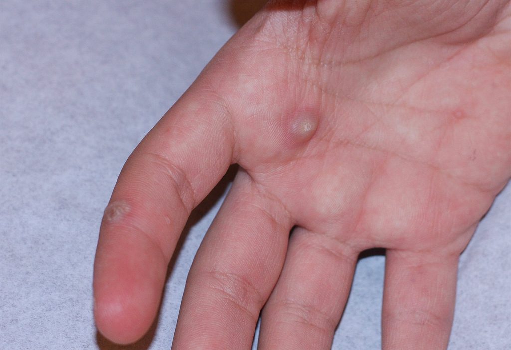 Photo of a wart on the hand.