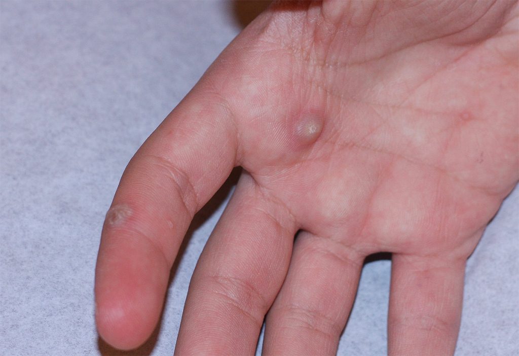 Warts on sale on hands