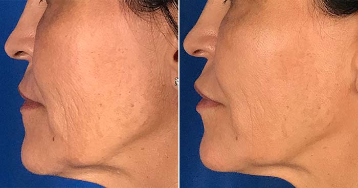 Restylane Defyne results in the lips, cheek, and nasolabial folds