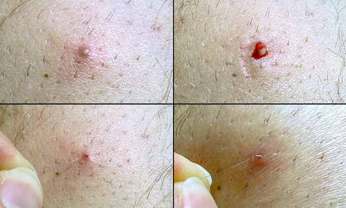 Inner thighs - deep scarring from ingrown hair cysts, stretch