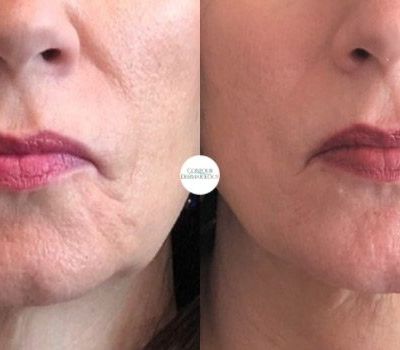 Sculptra for lines around the mouth