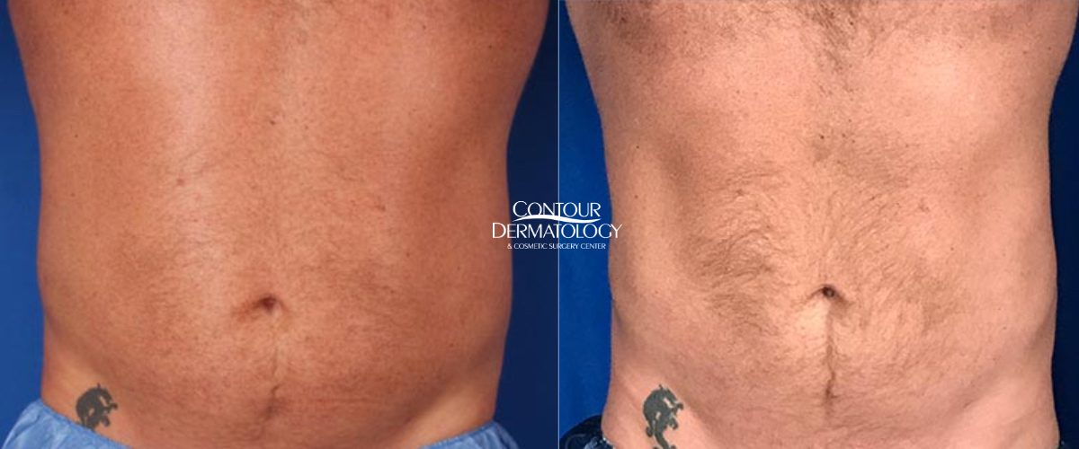 CoolSculpting Elite, reducing fat on tummy & flanks, before and after