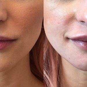 Restylane Lyft results for the lips
