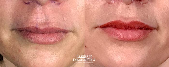 Lip Lift, 40 Year Old Female, 1 Month After