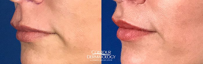 Lip Lift, 40 Year Old Female, 1 Month After
