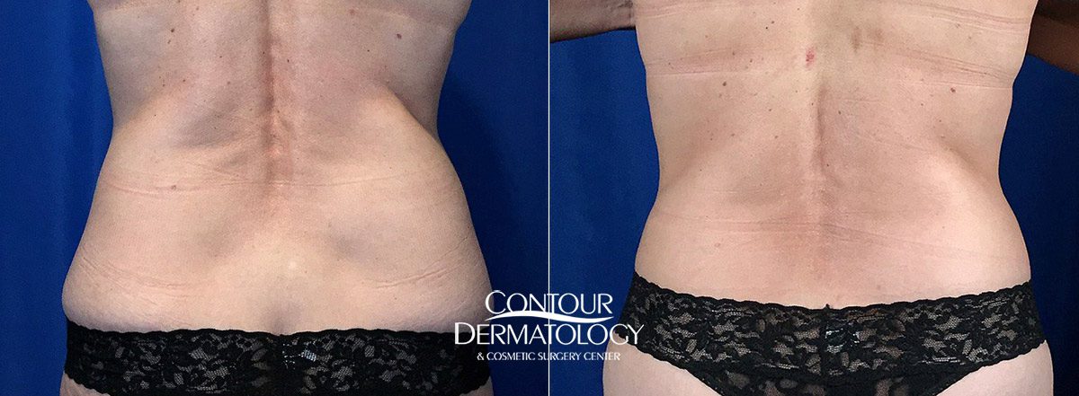 CoolSculpting® Flanks – Love Handles Photo Gallery