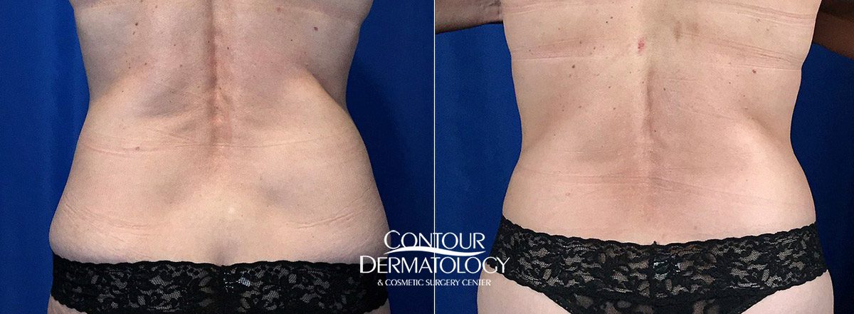 CoolSculpting - Upper & Lower Flanks Before & After Gallery - Case 4437