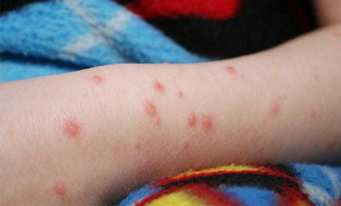 chicken pox scars on arms